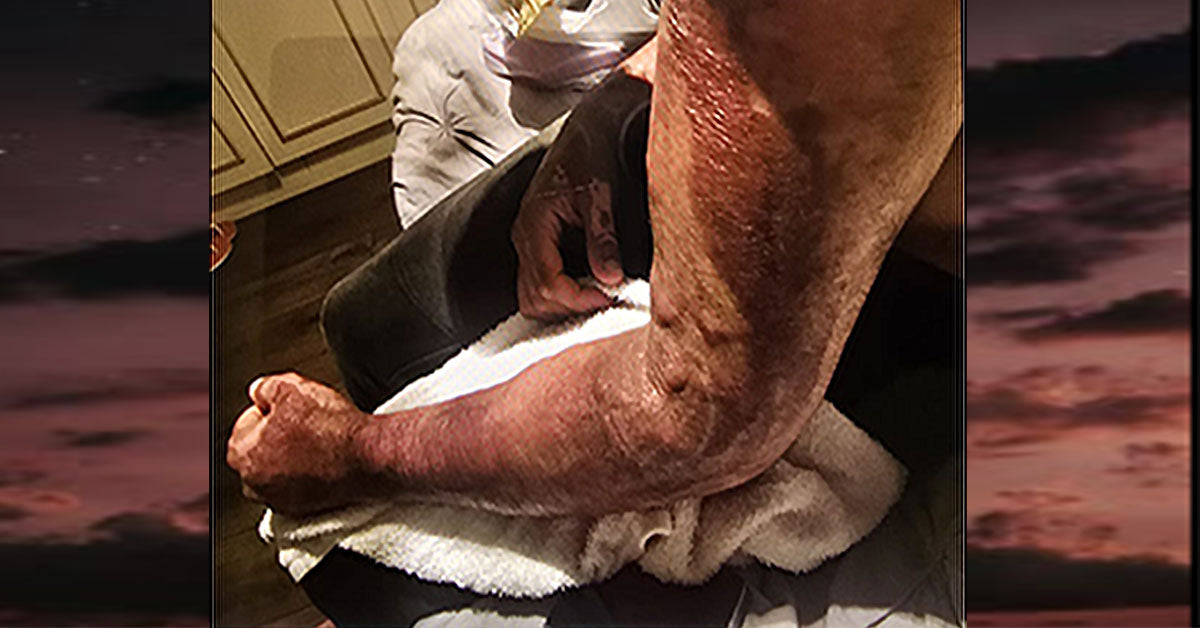 Khuram Rana Left Arm after trying to save mum in house fire. Fit Life London Personal Trainer and Survivor Mental Health awareness.  Personal Training in West London Southall UB1 at VIP studio 4 mins away from Southall Station with Free Parking
