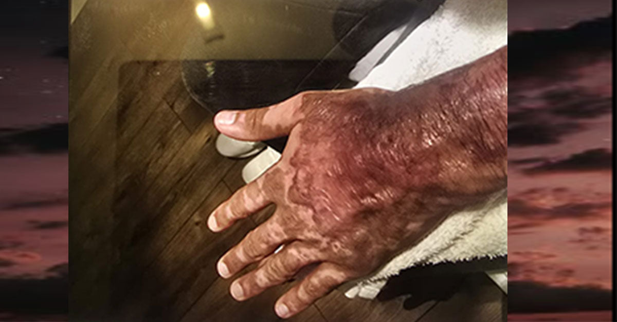 Khuram Rana Hand Burns after trying to save mum in house fire. Fit Life London Personal Trainer and Survivor Mental Health awareness.  Personal Training in West London Southall UB1 at VIP studio 4 mins away from Southall Station with Free Parking
